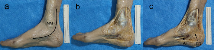 An anatomical approach to the tarsal tunnel syndrome: what can ankle's medial side anatomy reveal to us?