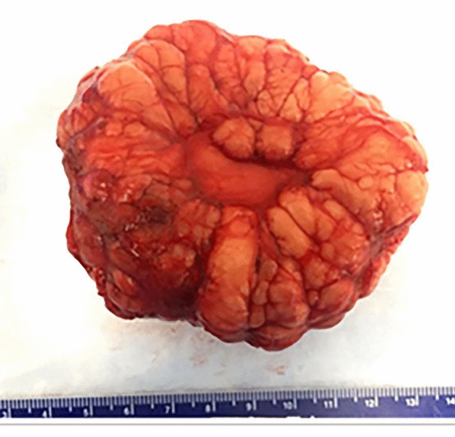 Chromothripsis in lipoblastoma: second reported case with complex PLAG1 rearrangement.