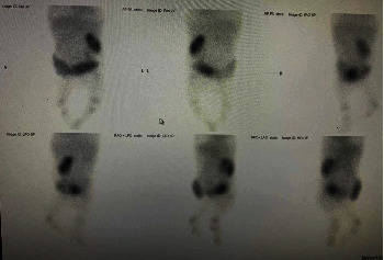 Prune Belly Syndrome in a Female Newborn following In Vitro Fertilization-Induced Pregnancy: A Case Report and Literature Review.