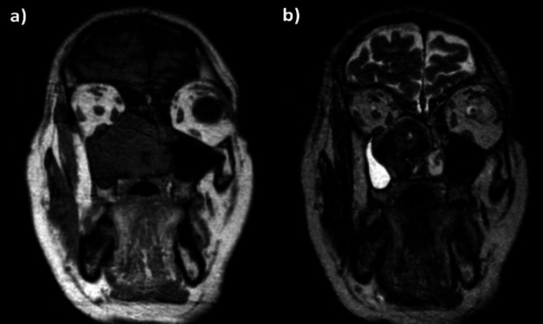 A Rare Case of Solitary Fibrosus Tumor (SFT) of the Nasal Septum.