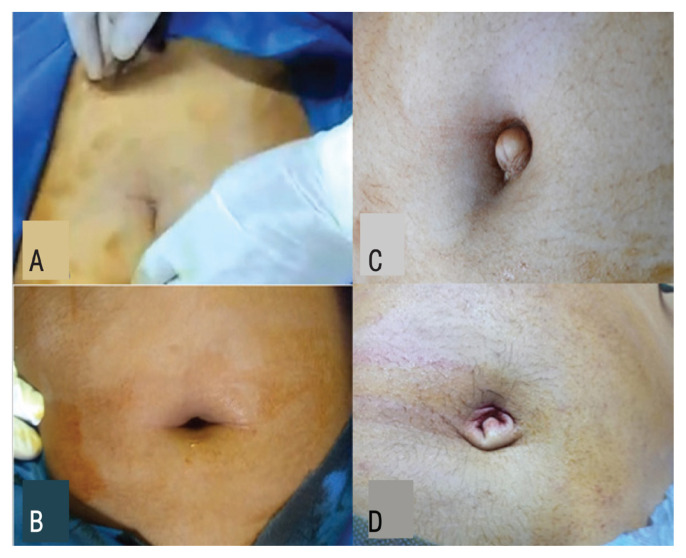 Intraoperative and Postoperative Outcomes of Modified Bidirectional Intra-Umbilical Incision versus Infra-Umbilical Incision for Direct Trocar Insertion in Gynaecological Laparoscopy: A randomised controlled trial.