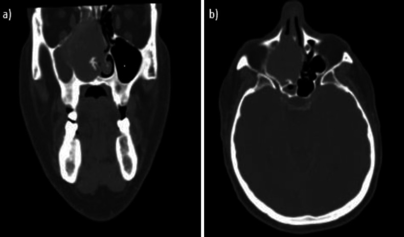 A Rare Case of Solitary Fibrosus Tumor (SFT) of the Nasal Septum.