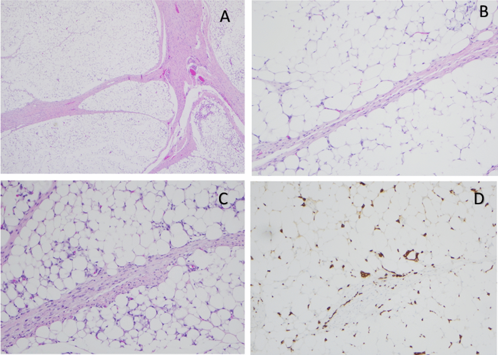 Chromothripsis in lipoblastoma: second reported case with complex PLAG1 rearrangement.