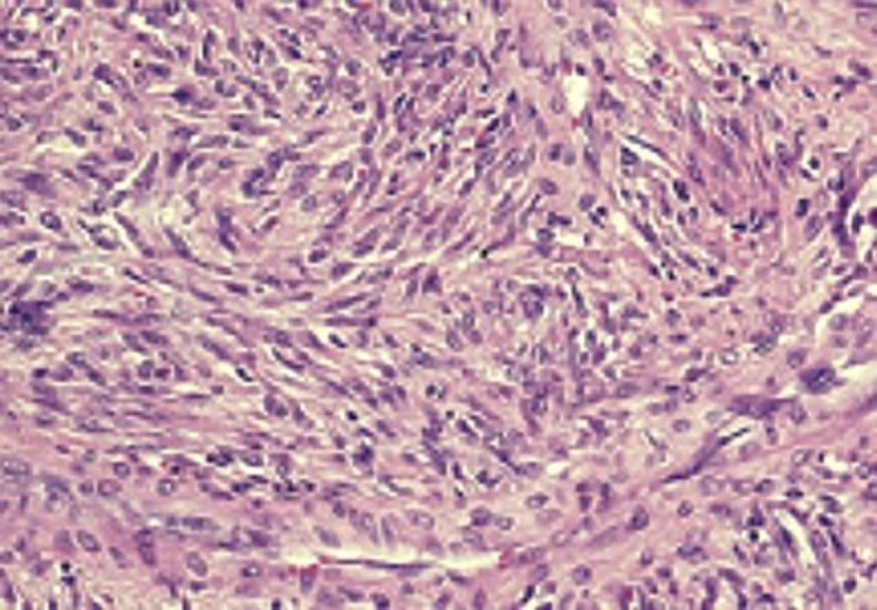 A Rare Case of Solitary Fibrosus Tumor (SFT) of the Nasal Septum.