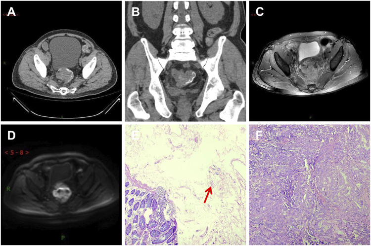 Conjoint analysis of clinical, imaging, and pathological features of schistosomiasis and colorectal cancer.