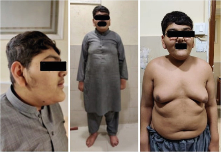 Borjeson-Forssman-Lehmann Syndrome: Clinical Features and Diagnostic Challenges.
