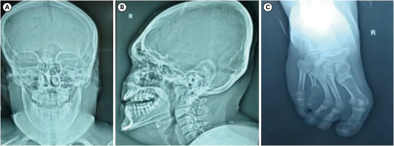 Borjeson-Forssman-Lehmann Syndrome: Clinical Features and Diagnostic Challenges.