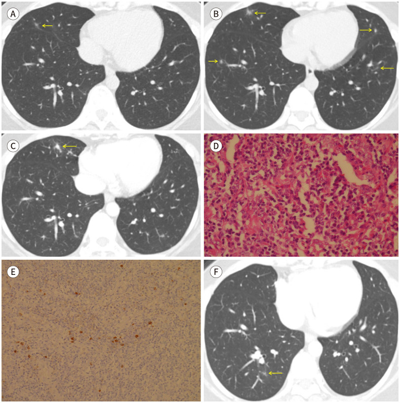 Immunoglobulin G4-Related Lung Disease with Waxing and Waning Pulmonary Infiltrates: A Case Report.