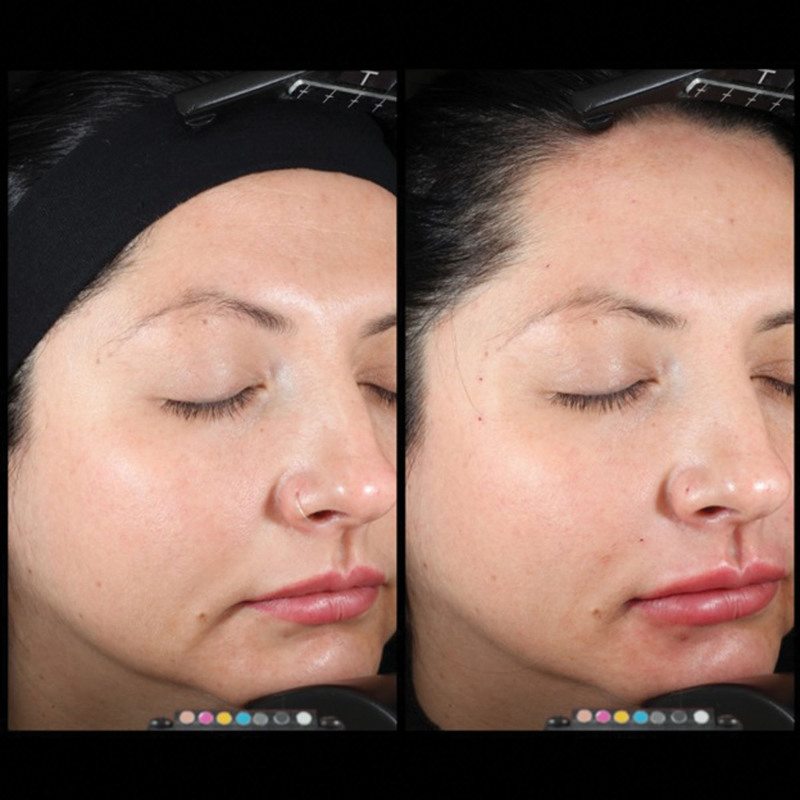 Global facial rejuvenation with one treatment of incobotulinumtoxinA, hyaluronic acid, and calcium hydroxyapatite results in long-term patient-reported satisfaction.