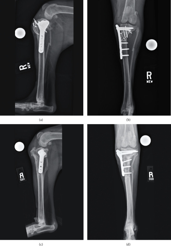 Use of Preoperative 3D Virtual Planning and 3D-Printed Patient-Specific Guides to Facilitate a Single-Stage Cranial Closing Wedge Ostectomy and Tibial Plateau Leveling Osteotomy Procedure to Address Proximal Tibial Deformity, an Excessive Tibial Plateau Angle, and Cranial Cruciate Ligament Insufficiency in a Dog.