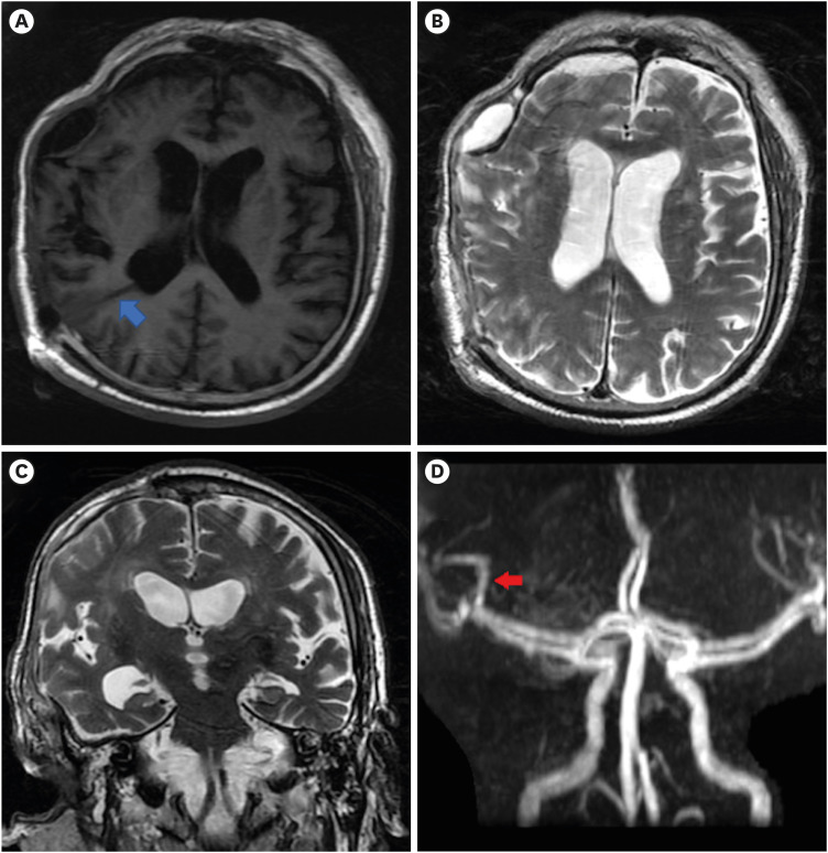 Middle Cerebral Artery Compromise Associated With Post-traumatic Hydrocephalus: A Case Report.