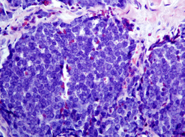 What's new in dermatopathology 2023: WHO 5th edition updates.