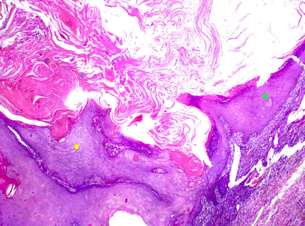 What's new in dermatopathology 2023: WHO 5th edition updates.