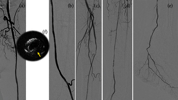 Angiographic and Clinical Impact of Novel Revascularization for Occluded Femoropopliteal Prosthetic Bypass Graft: A Combination of Surgical Thrombectomy and Drug-Coated Balloon Angioplasty.