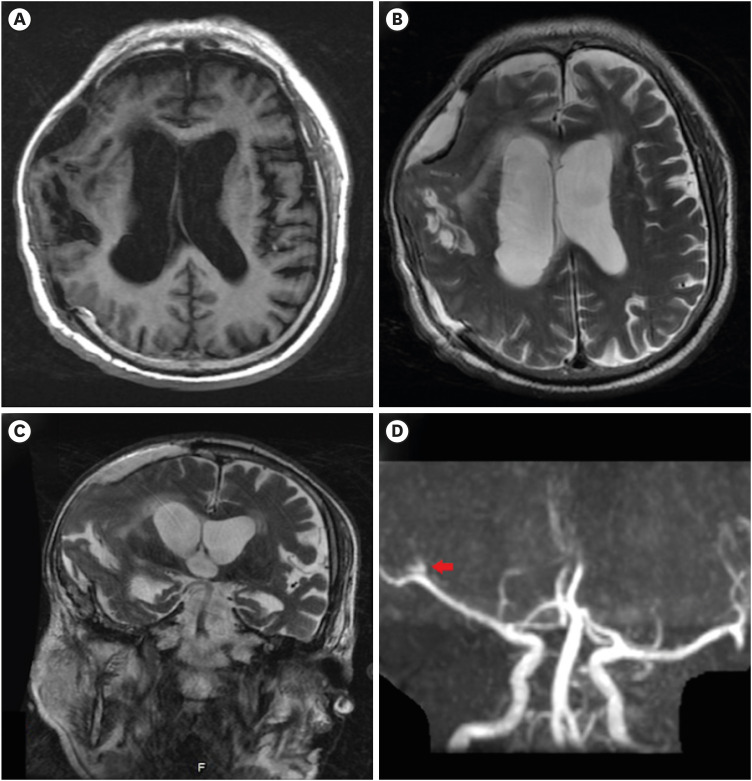 Middle Cerebral Artery Compromise Associated With Post-traumatic Hydrocephalus: A Case Report.