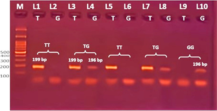 Detection of EGFR gene polymorphisms in non-small cell lung cancer Egyptian patients: a case-control study.