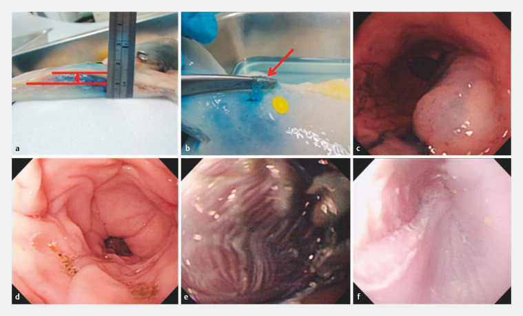 Development of a hybrid hydrogel for submucosal injection in endoscopic resection of gastrointestinal neoplasm: From laboratory to clinical trial.