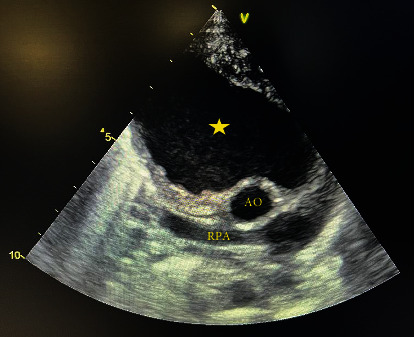 Aortic Pseudoaneurysm following Ventricular Septal Defect Closure in a Pediatric Patient: A Case Report and Literature Review.