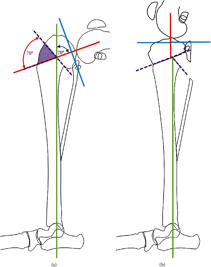 Use of Preoperative 3D Virtual Planning and 3D-Printed Patient-Specific Guides to Facilitate a Single-Stage Cranial Closing Wedge Ostectomy and Tibial Plateau Leveling Osteotomy Procedure to Address Proximal Tibial Deformity, an Excessive Tibial Plateau Angle, and Cranial Cruciate Ligament Insufficiency in a Dog.