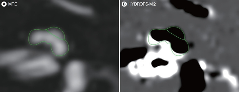 Findings of Intravenous Gadolinium Inner Ear Magnetic Resonance Imaging in Patients With Acute Low-Tone Sensorineural Hearing Loss.