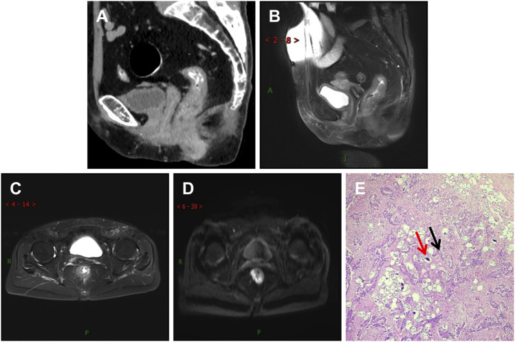 Conjoint analysis of clinical, imaging, and pathological features of schistosomiasis and colorectal cancer.