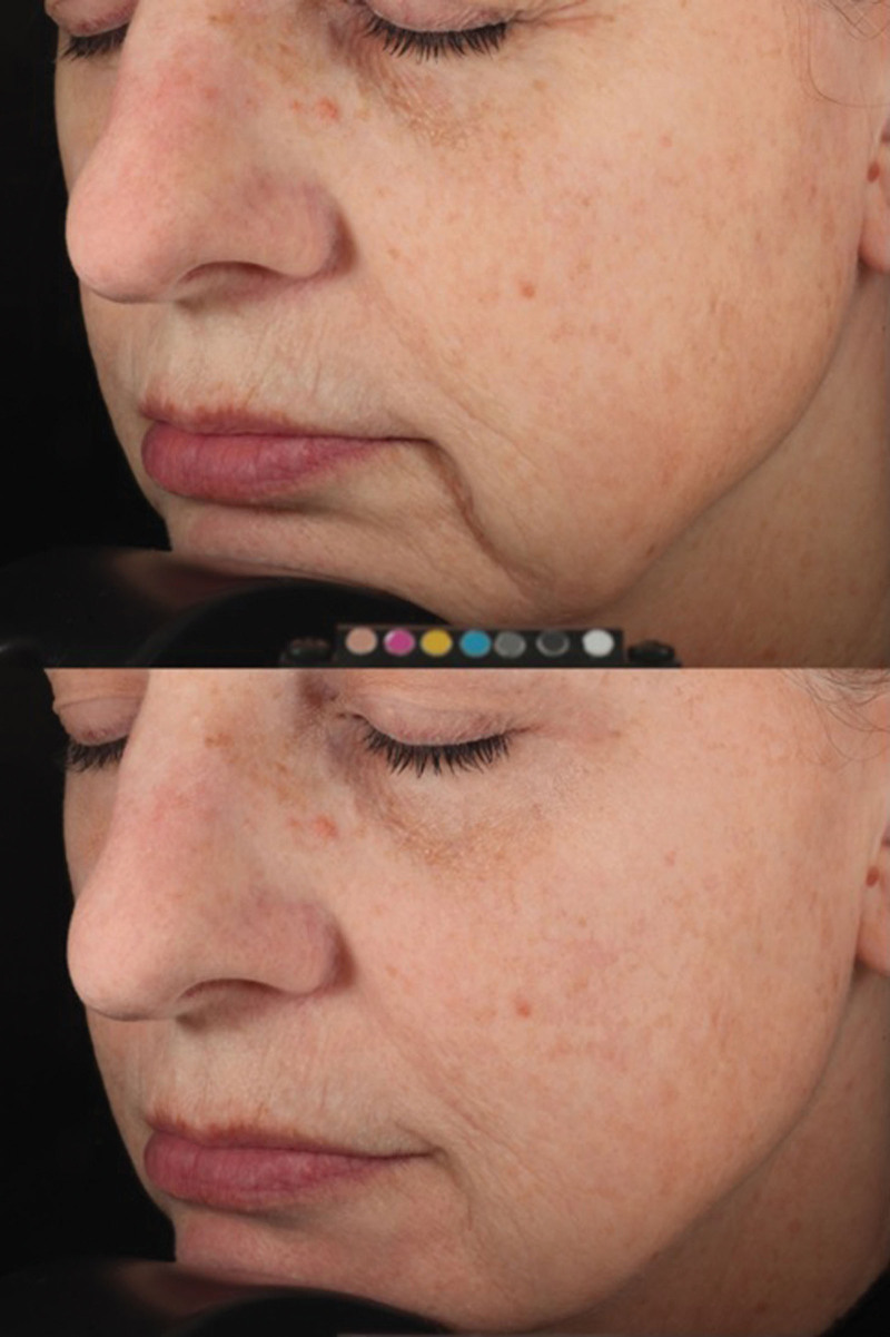 Global facial rejuvenation with one treatment of incobotulinumtoxinA, hyaluronic acid, and calcium hydroxyapatite results in long-term patient-reported satisfaction.