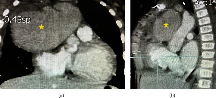 Aortic Pseudoaneurysm following Ventricular Septal Defect Closure in a Pediatric Patient: A Case Report and Literature Review.