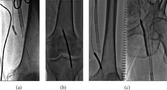 Angiographic and Clinical Impact of Novel Revascularization for Occluded Femoropopliteal Prosthetic Bypass Graft: A Combination of Surgical Thrombectomy and Drug-Coated Balloon Angioplasty.