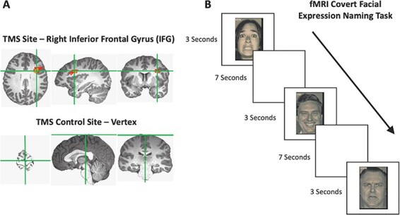 TMS disruption of the lateral prefrontal cortex increases neural activity in the default mode network when naming facial expressions.