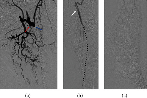 Angiographic and Clinical Impact of Novel Revascularization for Occluded Femoropopliteal Prosthetic Bypass Graft: A Combination of Surgical Thrombectomy and Drug-Coated Balloon Angioplasty.