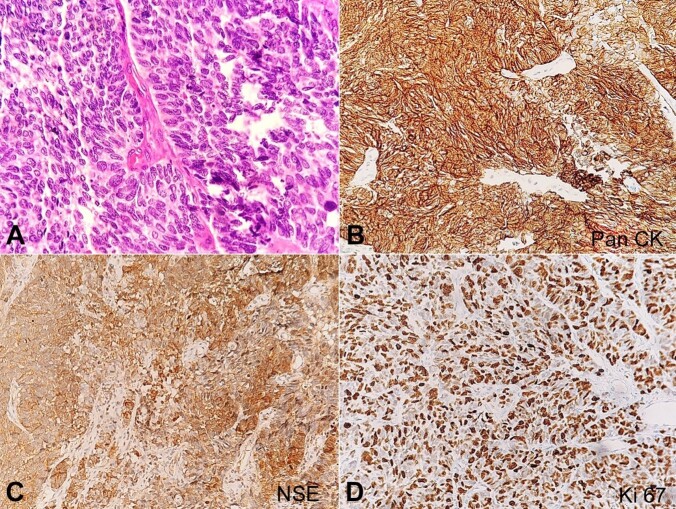 Small cell neuroendocrine carcinoma with adenocarcinoma and high grade squamous intraepithelial neoplasia of the cervix.
