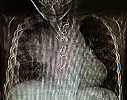 Aortic Pseudoaneurysm following Ventricular Septal Defect Closure in a Pediatric Patient: A Case Report and Literature Review.