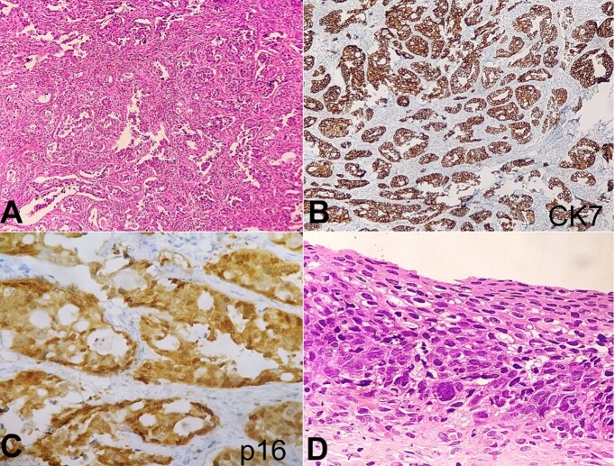 Small cell neuroendocrine carcinoma with adenocarcinoma and high grade squamous intraepithelial neoplasia of the cervix.