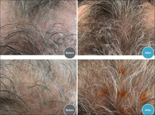 TH07 - A New Novel Topical Treatment for Androgenic Alopecia.