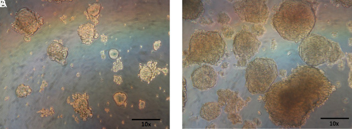 NANOG Dominates Interleukin-6-Induced Sphere Formation in Prostate Cancer.