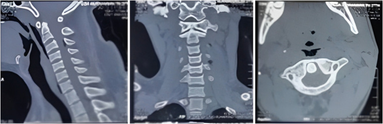 Penetrating Neck Injury Involving Wooden Foreign Bodies: Case Report.