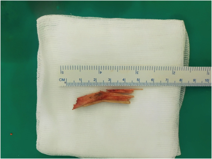 Penetrating Neck Injury Involving Wooden Foreign Bodies: Case Report.