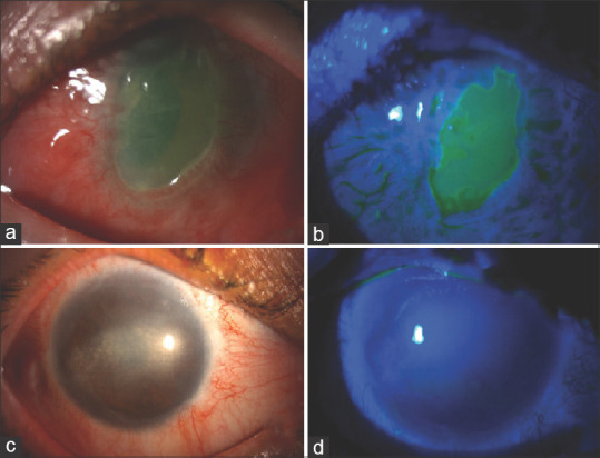 Use of Systemic Mycophenolate Mofetil Therapy in Ocular Surface Inflammatory Pathologies at the Initiative and Responsibility of the Ophthalmologist.