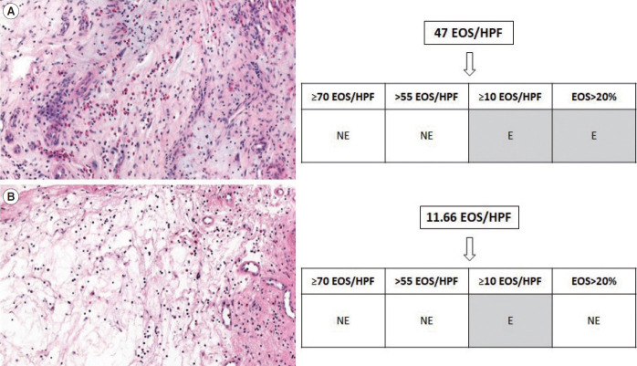 Differences in Clinical and Immunological Characteristics According to the Various Criteria for Tissue Eosinophilia in Chronic Rhinosinusitis With Nasal Polyps.