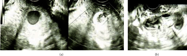 A Case of Ruptured Exophytic Uterine Artery Pseudoaneurysm without Specific Risk Factors That Manifested Seven Days after Vaginal Delivery.