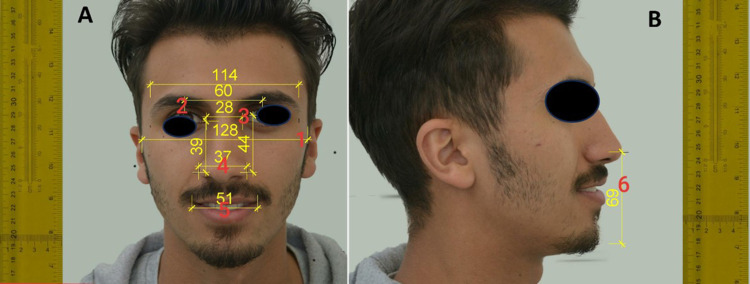 Correlation Between Maxillary Anterior Teeth and Common Facial Measurements.
