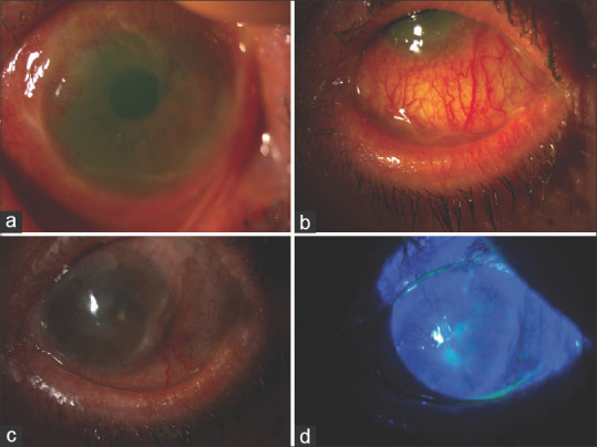 Use of Systemic Mycophenolate Mofetil Therapy in Ocular Surface Inflammatory Pathologies at the Initiative and Responsibility of the Ophthalmologist.