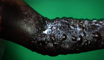 Bullous Hemorrhagic Dermatosis Induced by Enoxaparin: About a Case in Madagascar.