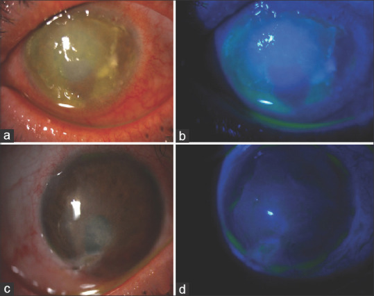 Use of Systemic Mycophenolate Mofetil Therapy in Ocular Surface Inflammatory Pathologies at the Initiative and Responsibility of the Ophthalmologist.