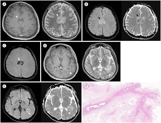 Necrotizing Primary Angiitis of the Central Nervous System Mimicking Brain Abscess: A Case Report and Literature Review.