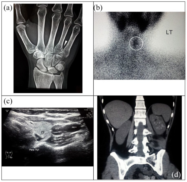 Hypovitaminosis D masking hypercalcemia in primary hyperparathyroidism: case report.