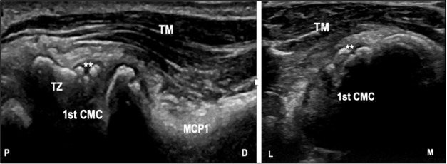 Effectiveness of Ultrasound-guided versus Landmark-based Glucocorticoid Injection in the Treatment of First Carpometacarpal Joint Osteoarthritis.