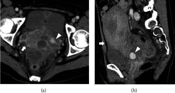 A Case of Ruptured Exophytic Uterine Artery Pseudoaneurysm without Specific Risk Factors That Manifested Seven Days after Vaginal Delivery.
