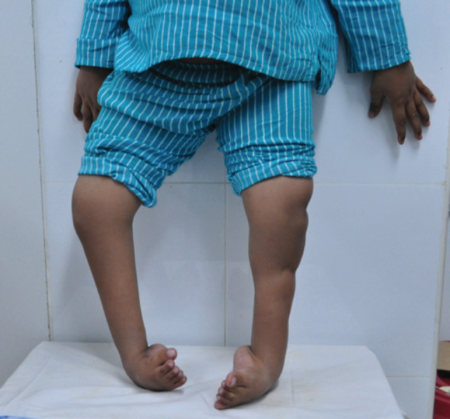 Outcomes of Management of Severe Clubfoot among Children by Ilizarov External Fixator.