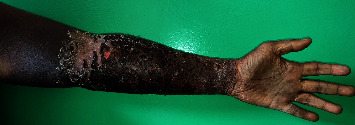 Bullous Hemorrhagic Dermatosis Induced by Enoxaparin: About a Case in Madagascar.